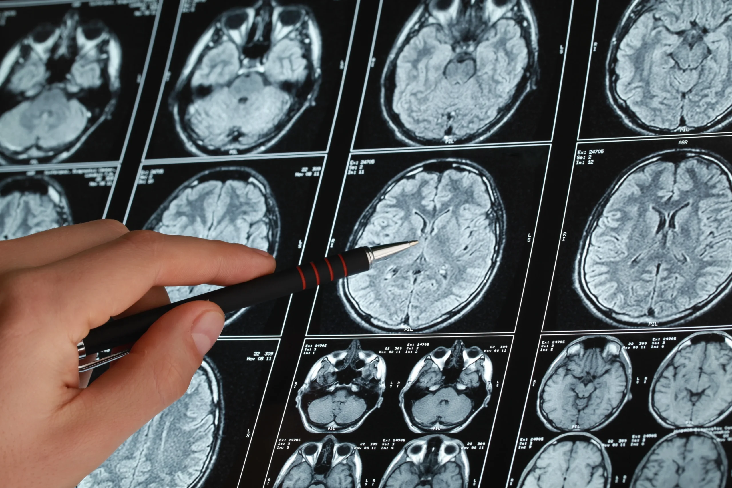 Brain hemorrhage Surgery